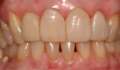 Using Crowns & Veneers – Pitfalls and Essentials to Know