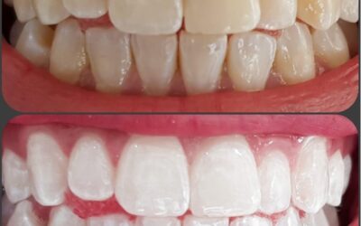 Using Crowns & Veneers – Pitfalls and Essentials to Know