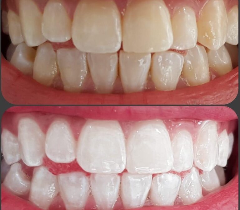 Using Crowns & Veneers – Pitfalls and Essentials to Know